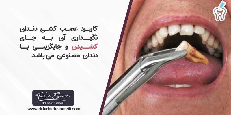 کاربرد عصب کشی دندان
