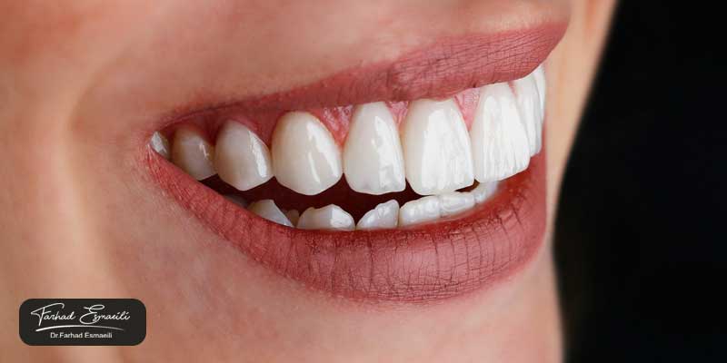 قیمت لمینت دندان در اصفهان