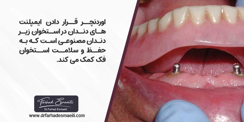 وردنچر قرار دادن ایمپلنت‌های دندان در استخوان زیر دندان مصنوعی است که به حفظ و سلامت استخوان فک کمک می کند.