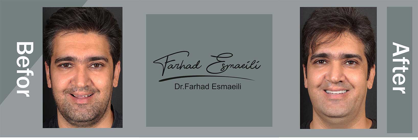 نمونه درمان ایمپلنت دیجیتال در اصفهان توسط دکتر فرهاد اسماعیلی