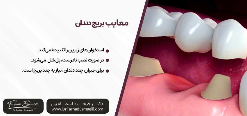 معایب بریج دندان