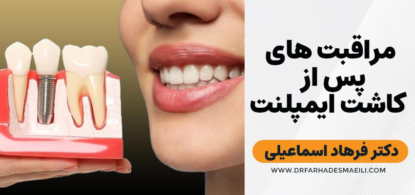 مراقبت های پس از کاشت ایمپلنت