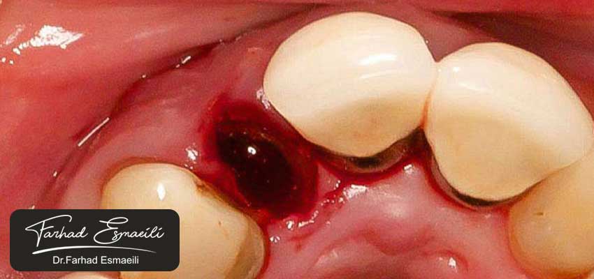 افراد سیگاری چگونه میتوانند از حفره خشک جلوگیری کنند؟