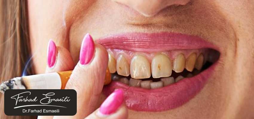 چه مدت پس از انجام پیوند استخوان میتوان سیگار کشید؟