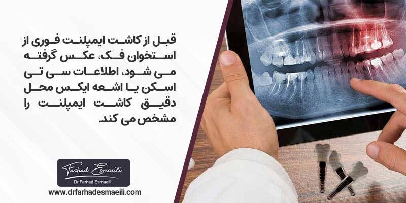 مراحل و شرایط انجام ایمپلنت فوری
