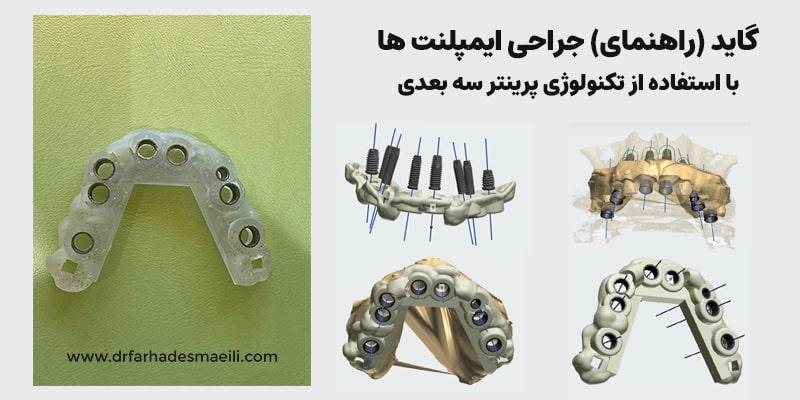 گاید (راهنمای) جراحی ایمپلنت ها