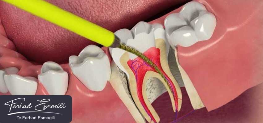 درمان ریشه دندان در اصفهان