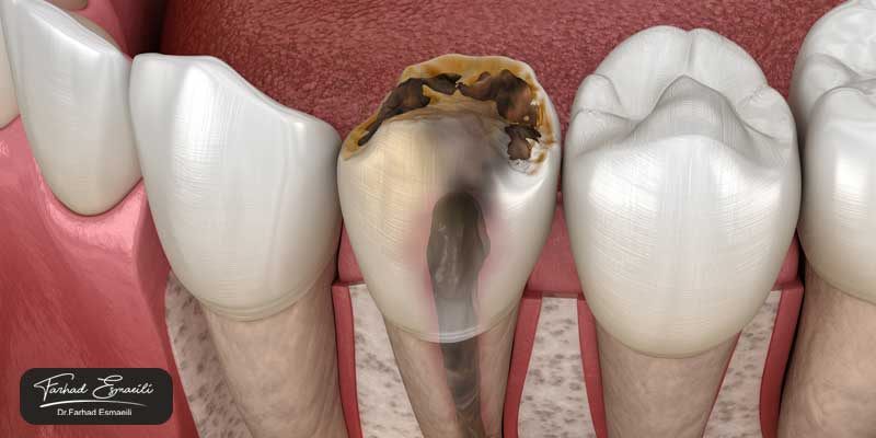 فرق درمان ریشه دندان با عصب کشی