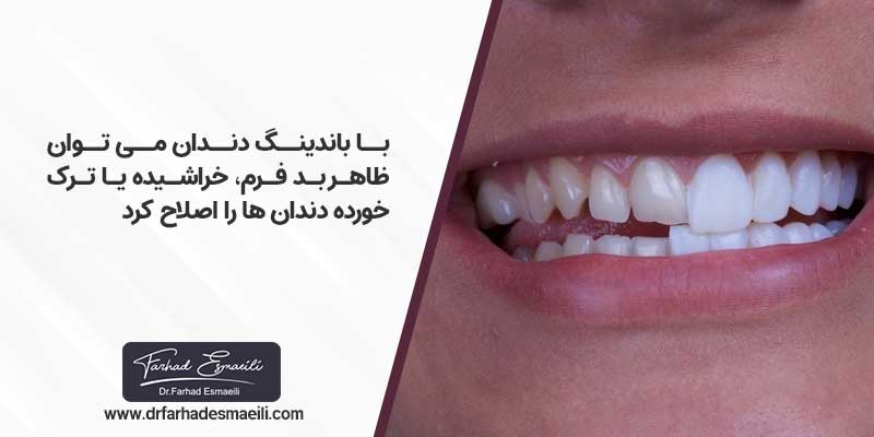 اصلاح طرح لبخند با باندینگ دندان