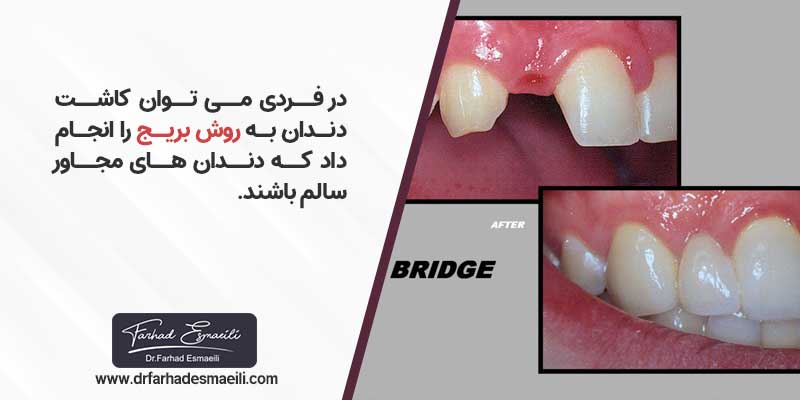 کاشت دندان به روش بریج