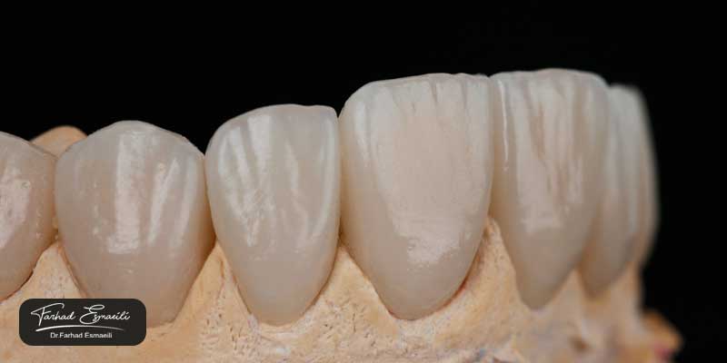 بهترین دکتر برای لمینت دندان در اصفهان چه ویژگی‌هایی دارد؟