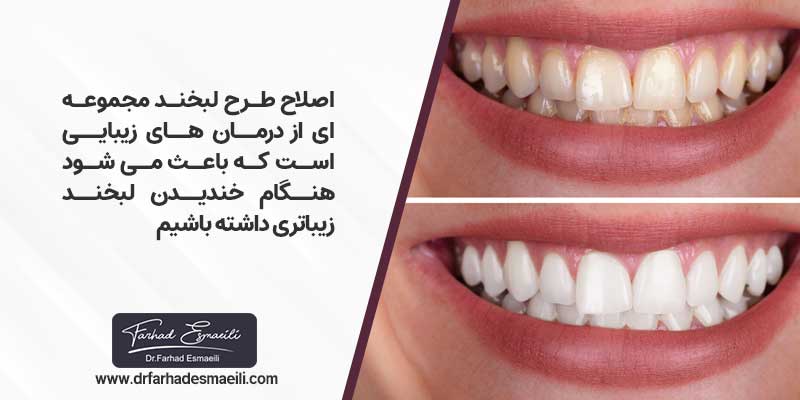 طراحی لبخند چیست؟
