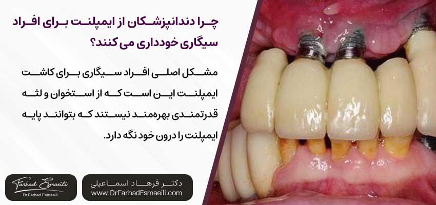 چرا دندانپزشکان معمولاً از کاشت ایمپلنت برای افراد سیگاری خودداری میکنند؟