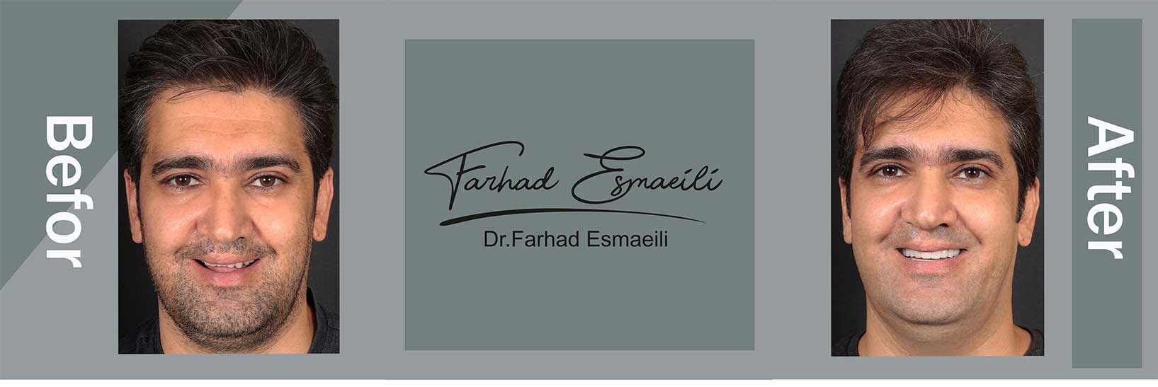 نمونه ایمپلنت یک روزه در اصفهان توسط دکتر فرهاد اسماعیلی