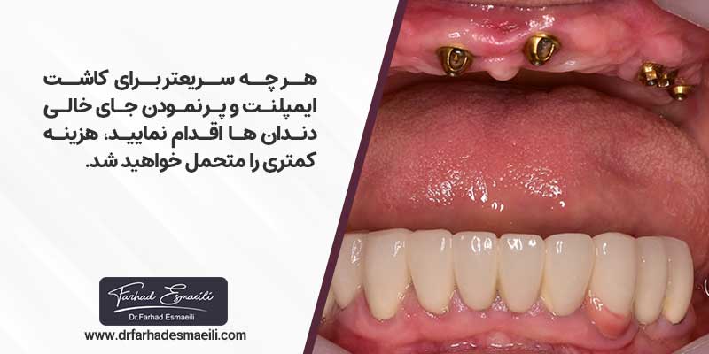 قیمت ایمپلنت در اصفهان