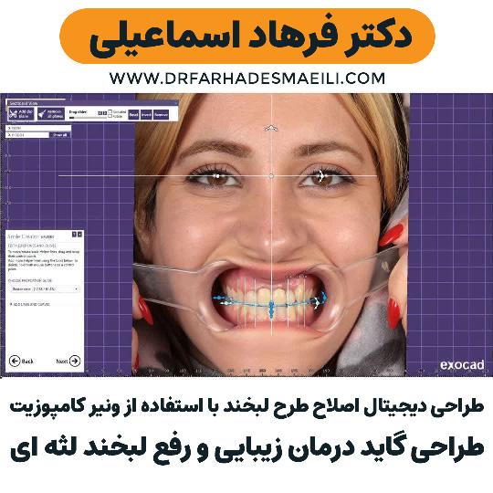 ونیر کامپوزیت با استفاده از تکنیک دیجیتال در اصفهان