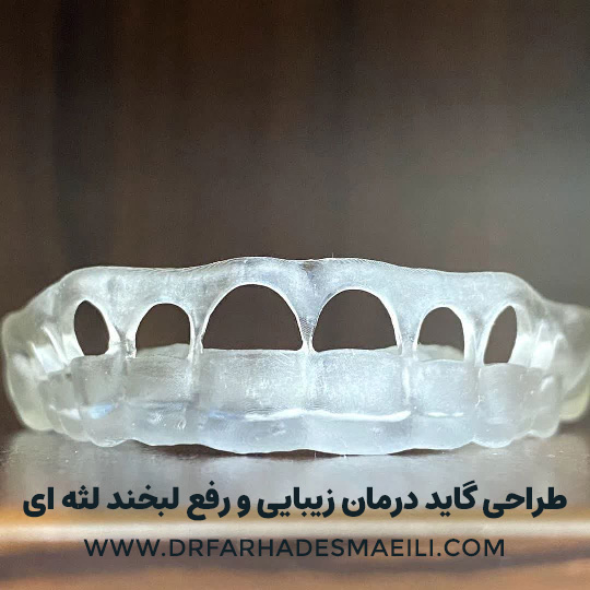 ونیر کامپوزیت با استفاده از تکنیک دیجیتال در اصفهان