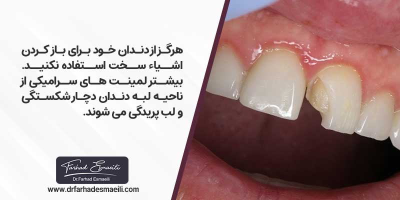 عدم جویدن غذاهای سفت جهت مراقبت از لمینت دندان