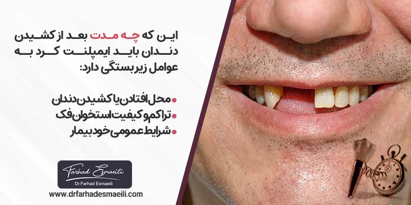 چه مدت بعد از کشیدن دندان می توان ایمپلنت کرد؟
