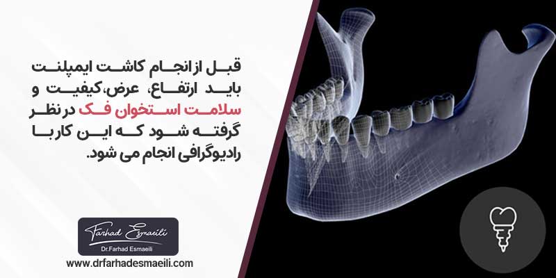 اهمیت سلامت استخوان فک و بالا بودن تراکم استخوان در کاشت ایمپلنت