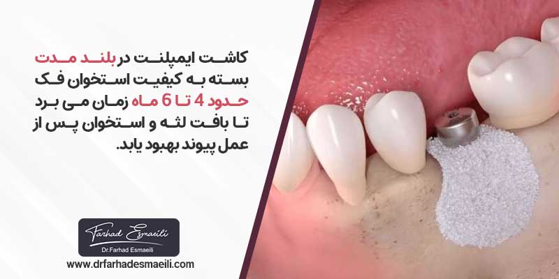 کاشت ایمپلنت در بلند مدت