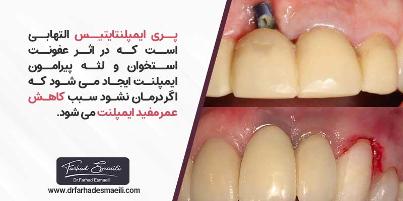 عوامل تاثیر گذار بر روی کاهش ماندگاری ایمپلنت دندان