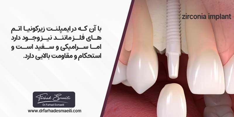 ایمپلنت زیرکونیا