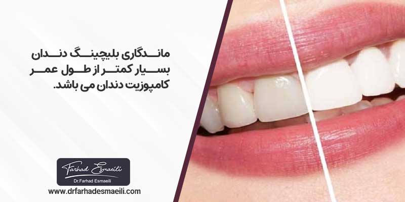 ماندگاری کامپوزیت بیشتر است یا بلیچینگ؟