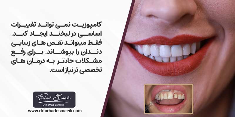 کامپوزیت دندان