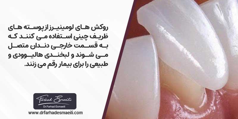 لبخند هالیودی با روکش لومینیرز