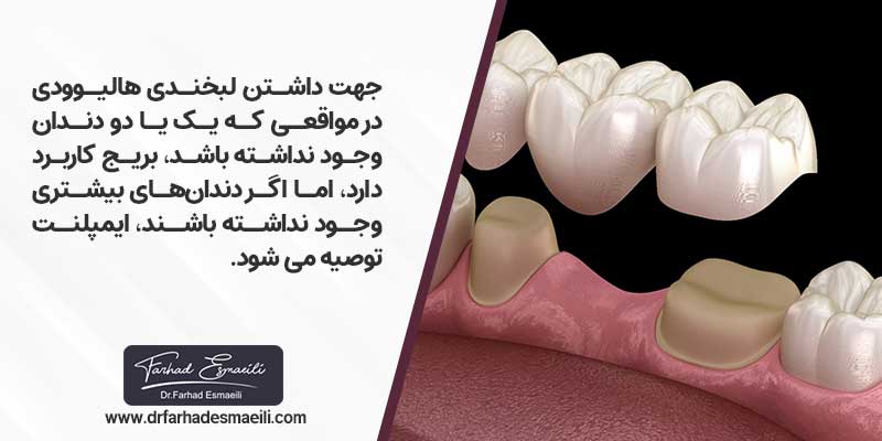 لبخند هالیوودی با استفاده از بریج دندان