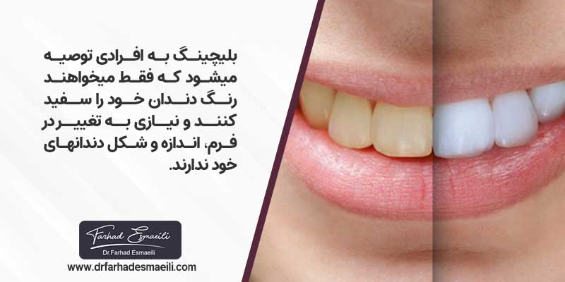 بلیچینگ دندان