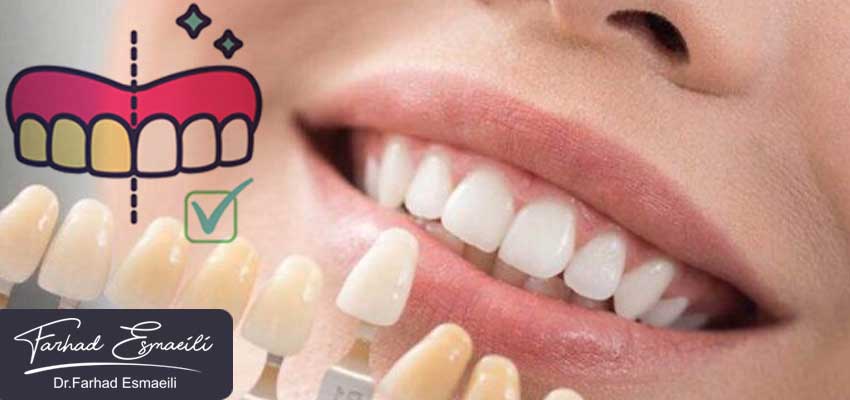 تفاوت بلیچینگ یاسفید کردن دندان و کامپوزیت دندان