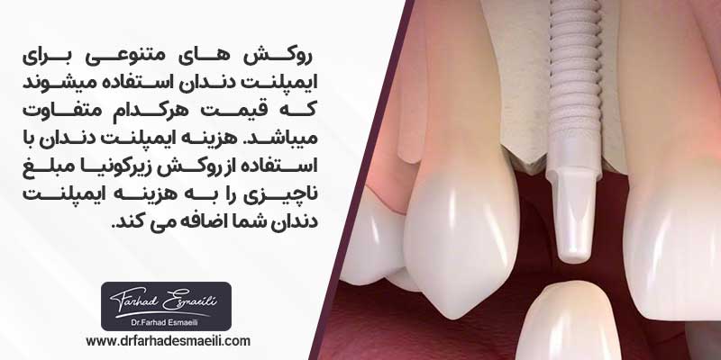 هزینه های جانبی تاثیر گذار بر روی اقساط ایمپلنت دندان