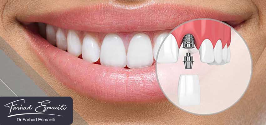 شرایط مناسب برای انجام ایمپلنت های فوری در اصفهان توسط دکتر فرهاد اسماعیلی
