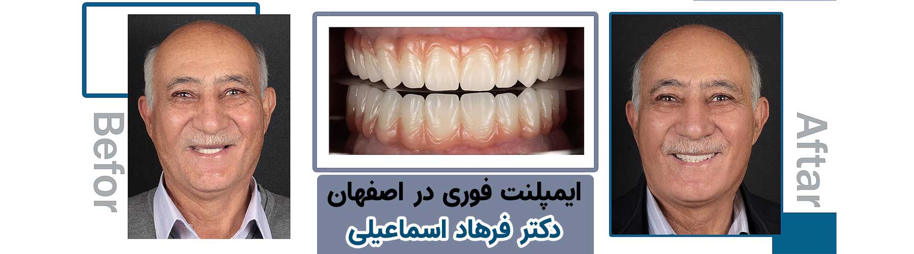 درمان بی دندانی با استفاده از ایمپلنت دیجیتال توسط دکتر فرهاد اسماعیلی