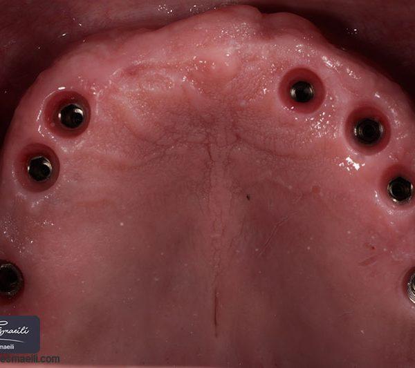 درمان بی دندانی با ایمپلنت دیجیتال بدون درد و خونریزی