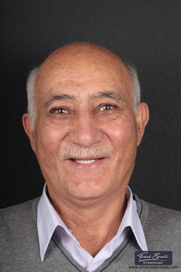 درمان بی دندانی با استفاده از ایمپلنت دیجیتال