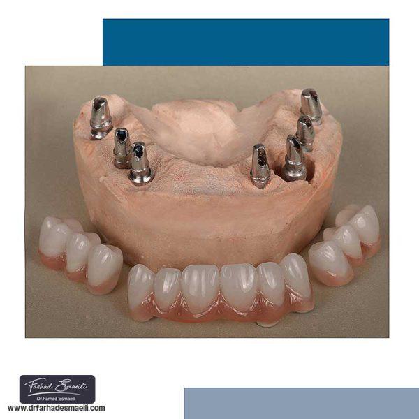 درمان بی دندانی با ایمپلنت دیجیتال توسط دکتر فرهاد اسماعیلی