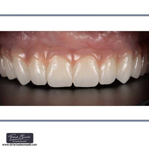 درمان بی دندانی با ایمپلنت دیجیتال توسط دکتر فرهاد اسماعیلی