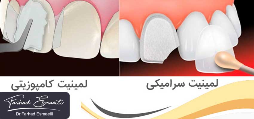 ونیرهای کامپوزیتی بهترند یا سرامیکی؟