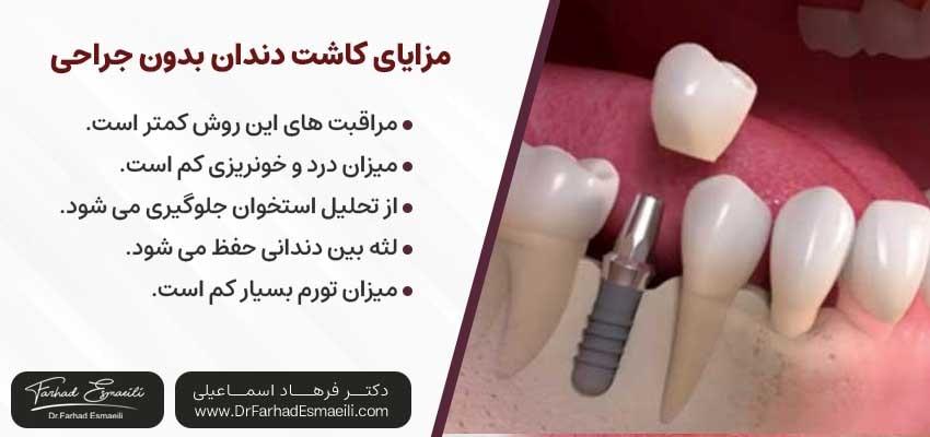 مزایای ایمپلنت دندان بدون جراحی | دکتر فرهاد اسماعیلی متخصص ایمپلنت اصفهان
