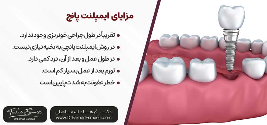 مزایای ایمپلنت پانچ| دکتر فرهاد اسماعیلی متخصص ایمپلنت اصفهان