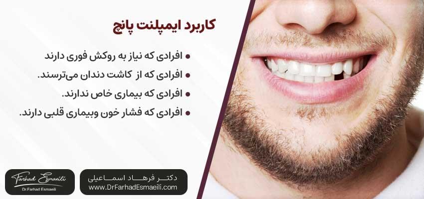 کاربرد اایمپلنت پانچ| دکتر فرهاد اسماعیلی متخصص ایمپلنت اصفهان