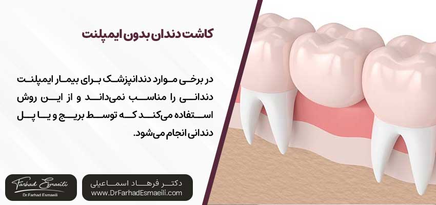 کاشت دندان بدون ایمپلنت با تکنولوژی جدید
