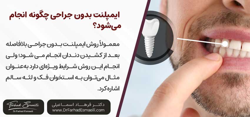 ایمپلنت بدون جراحی چگونه انجام میشود؟ | دکتر فرهاد اسماعیلی متخصص ایمپلنت اصفهان