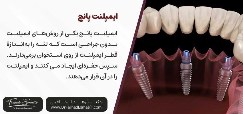 ایمپلنت پانچ | دکتر فرهاد اسماعیلی متخصص ایمپلنت اصفهان