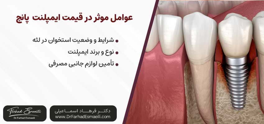 قیمت ایمپلنت پانچ | دکتر فرهاد اسماعیلی متخصص ایمپلنت اصفهان