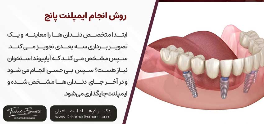 روش انجام ایمپلنت پانچ| دکتر فرهاد اسماعیلی متخصص ایمپلنت اصفهان