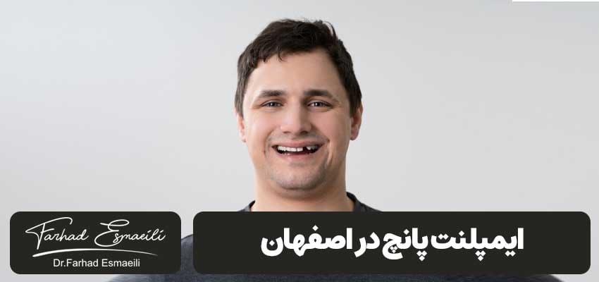 ایمپلنت پانچ در اصفهان